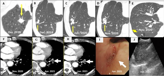 case study of a lung cancer patient figure 1