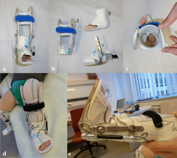 Is Unilateral Lower Leg Orthosis With A Circular Foot Unit In The Treatment Of Idiopathic Clubfeet A Reasonable Bracing Alternative In The Ponseti Method Five Year Results Of A Supraregional Paediatric Orthopaedic Centre