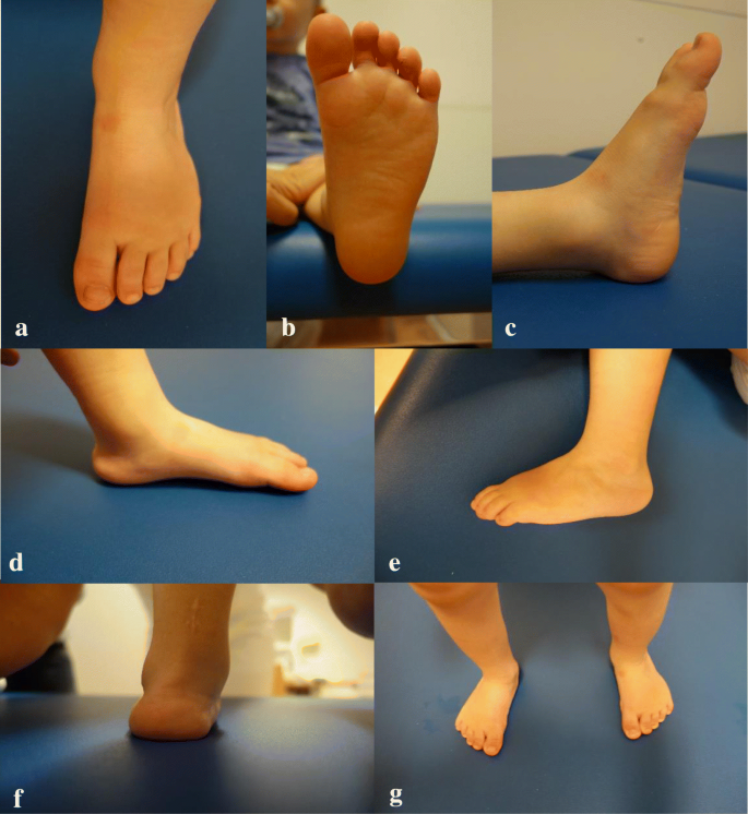 Is Unilateral Lower Leg Orthosis With A Circular Foot Unit In The Treatment Of Idiopathic Clubfeet A Reasonable Bracing Alternative In The Ponseti Method Five Year Results Of A Supraregional Paediatric Orthopaedic Centre