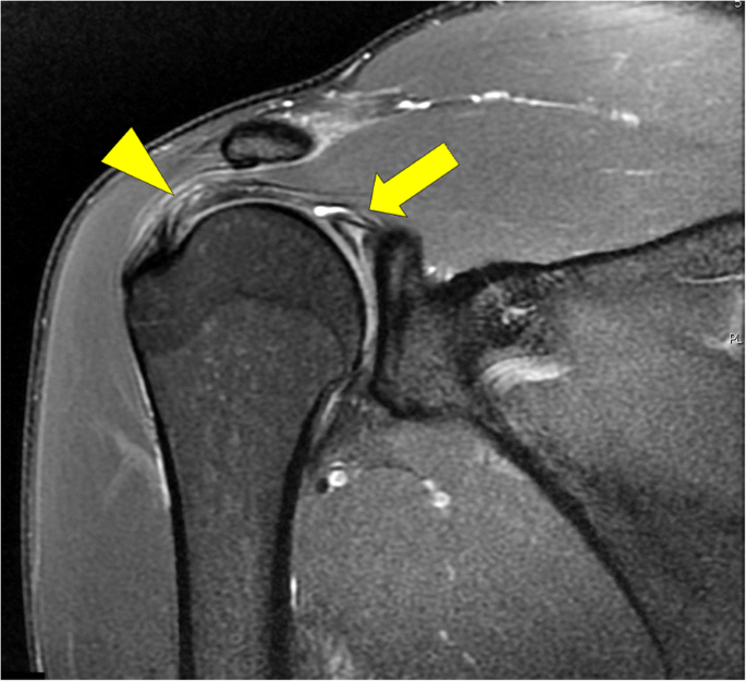 The epidemiology of MRI detected shoulder injuries in athletes  participating in the Rio de Janeiro 2016 Summer Olympics | BMC  Musculoskeletal Disorders | Full Text