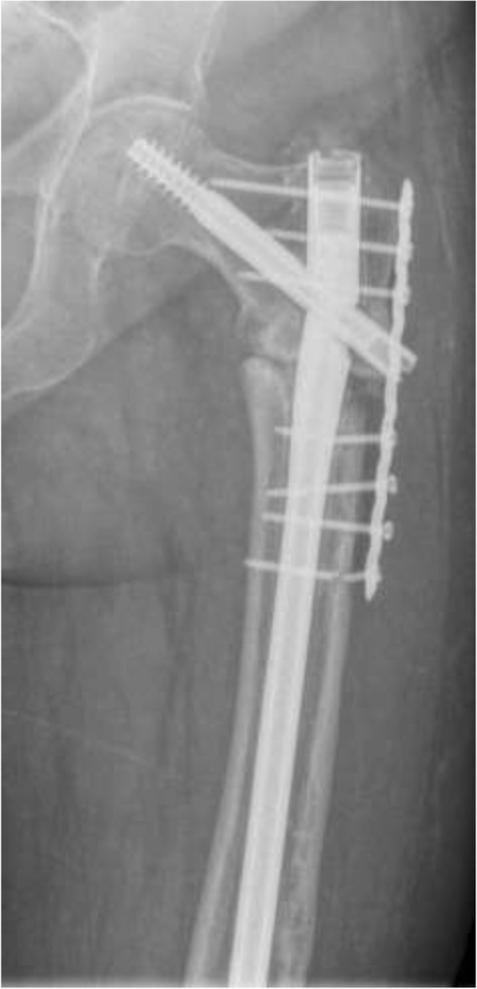 Revision of subtrochanteric femoral nonunions after intramedullary nailing  with dynamic condylar screw” | BMC Musculoskeletal Disorders | Full Text