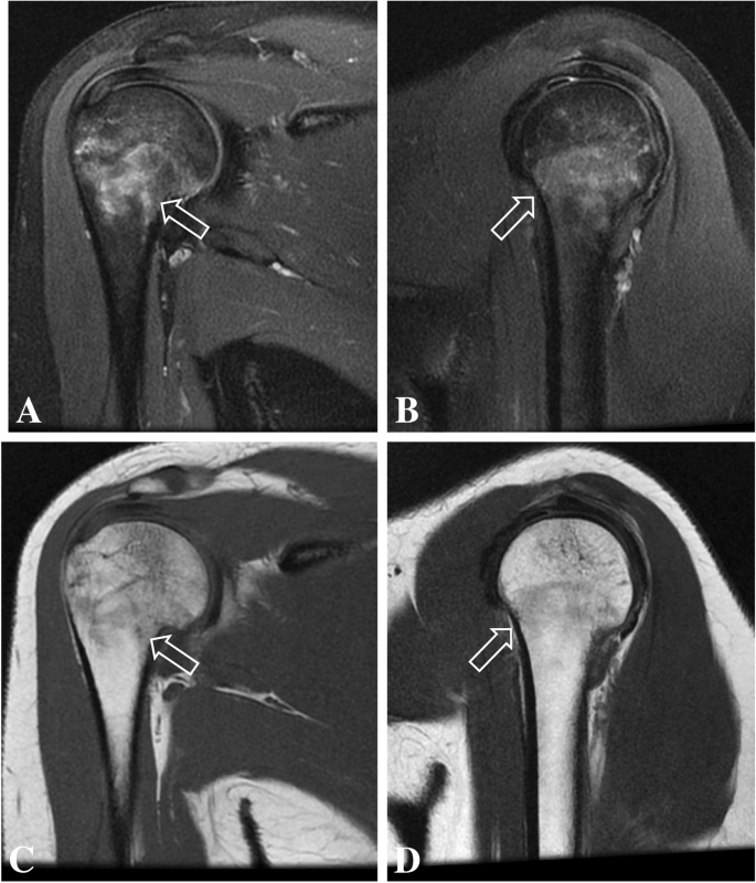 Humeral stress fracture in a female CrossFit athlete: a case report | BMC  Musculoskeletal Disorders | Full Text