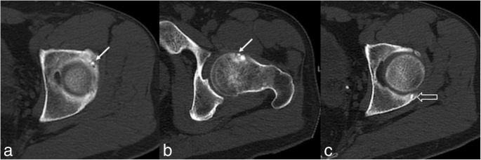 Multicentric Multifocal And Recurrent Osteoid Osteoma Of The Hip First Case Report Bmc Musculoskeletal Disorders Full Text