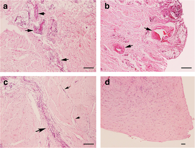 Innervation Of Nociceptors In Intact Human Menisci Along The Longitudinal Axis Semi Quantitative Histological Evaluation And Clinical Implications Bmc Musculoskeletal Disorders Full Text