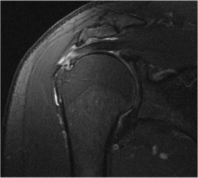 supraspinatus tear mri