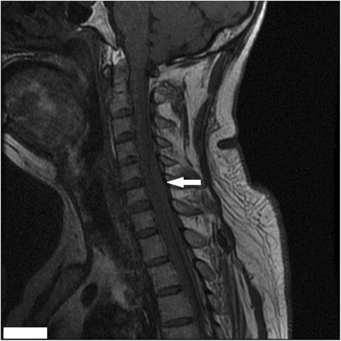 spinal epidural hematoma