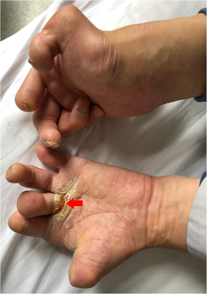Charcot neuroarthropathy of the knee due to idiopathic sensory peripheral  neuropathy | BMC Musculoskeletal Disorders | Full Text