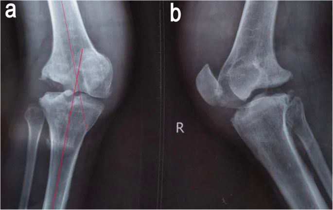 Charcot neuroarthropathy of the knee due to idiopathic sensory peripheral  neuropathy | BMC Musculoskeletal Disorders | Full Text