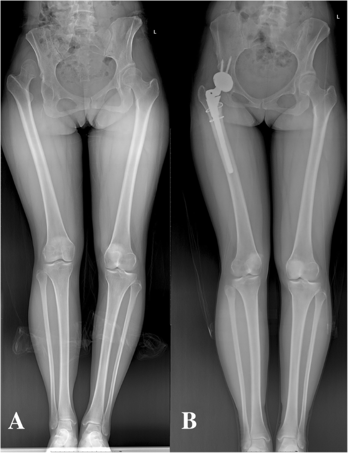 Calculation Method To Predict Postoperative Limb Length In Patients  Undergoing Tha Following Developmental Dysplasia Of Hips | Bmc  Musculoskeletal Disorders | Full Text