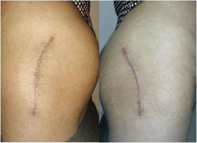 Tissue Adhesive For Wound Closure In Enhanced-Recovery Total Hip  Arthroplasty: A Prospective, Randomized And Controlled Study | Bmc  Musculoskeletal Disorders | Full Text