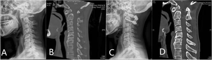 Surgical Treatment Of Atlantoaxial Subluxation By Intraoperative Skull Traction And C1 C2 Fixation Bmc Musculoskeletal Disorders Full Text