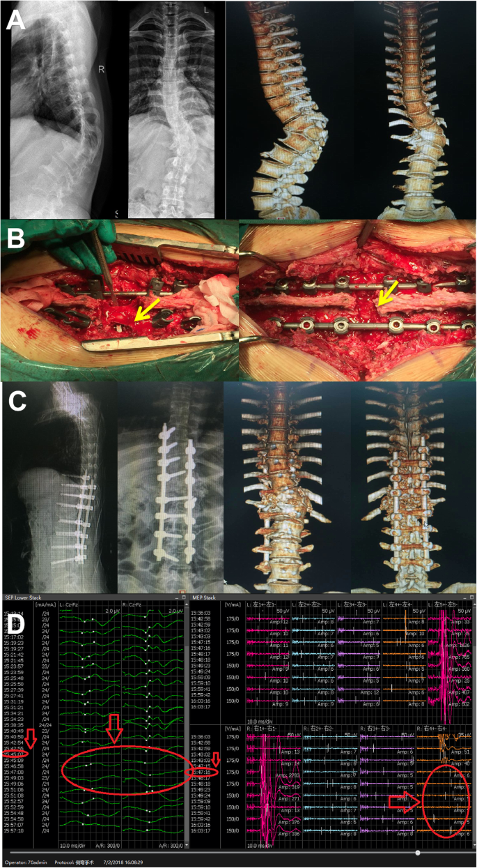 Protection Of L1 Nerve Roots By Pre Relieve Tension In Parallel Endplate Osteotomy For Severe Rigid Thoracolumbar Spine Deformity Bmc Musculoskeletal Disorders Full Text