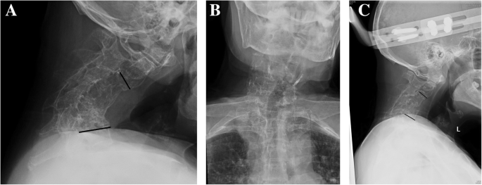 kyphotic cervical spine