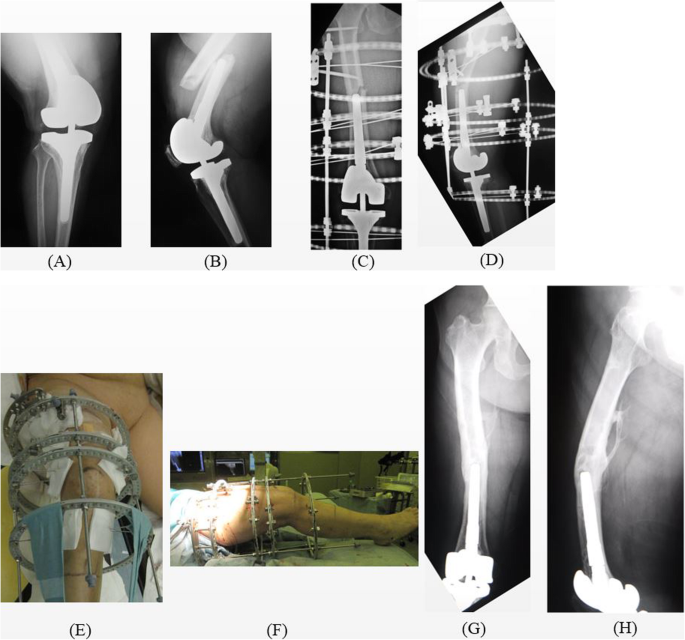 Effectiveness of circular external fixator in periprosthetic fractures  around the knee | BMC Musculoskeletal Disorders | Full Text