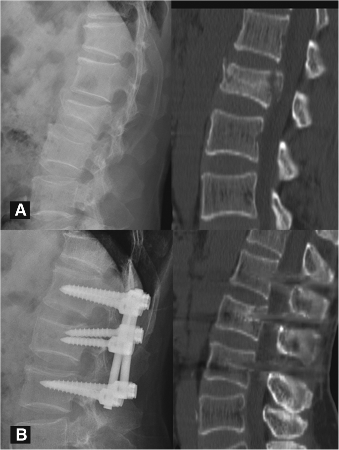 burst fracture burst fracture