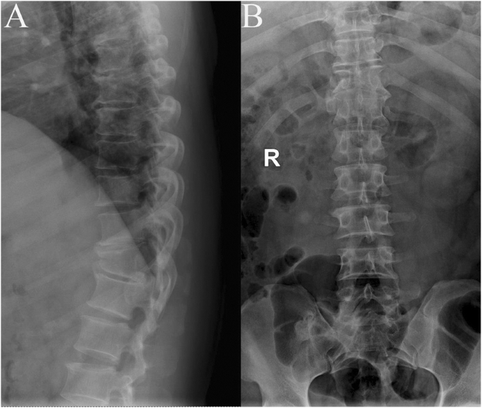Spinal Cord Injury In An Adult Patient With Thoracic Butterfly Vertebra A Case Report And Review Of The Literature Bmc Musculoskeletal Disorders Full Text