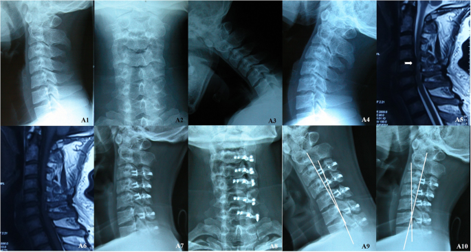 Is Laminectomy And Fusion The Better Choice Than Laminoplasty For Multilevel Cervical Myelopathy With Signal Changes On Magnetic Resonance Imaging A Comparison Of Two Posterior Surgeries Bmc Musculoskeletal Disorders Full Text
