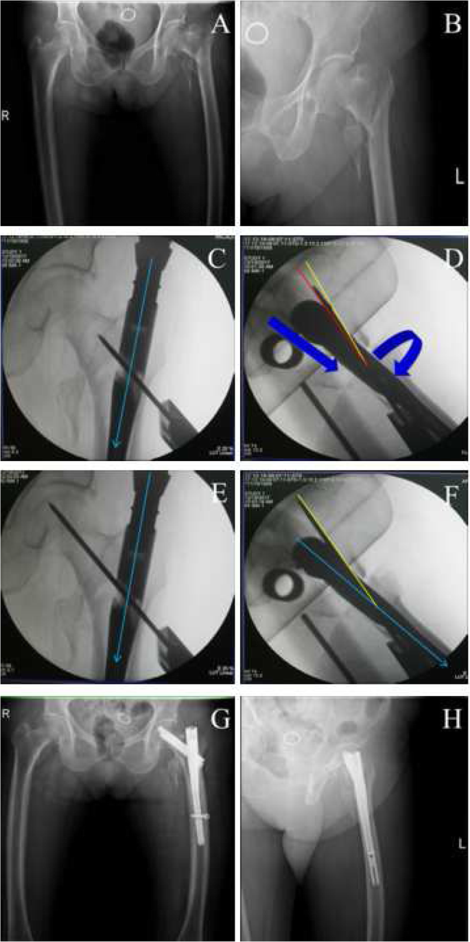 How to get better TAD? Relationship between anteversion angle of nail and  position of femoral neck guide pin during nailing of intertrochanteric  fractures | BMC Musculoskeletal Disorders | Full Text