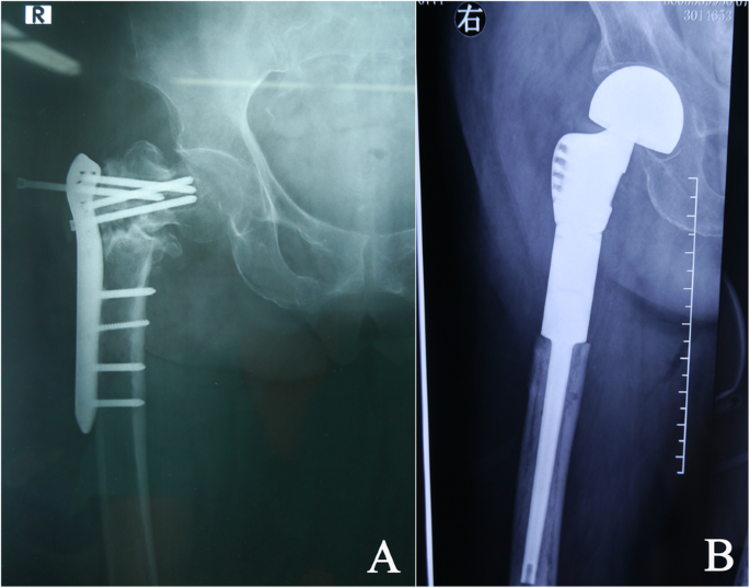Revision surgery due to failed internal fixation of intertrochanteric  femoral fracture: current state-of-the-art | BMC Musculoskeletal Disorders  | Full Text