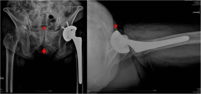 Anterior Dislocation Of Tha After Iliopsoas Tenotomy In Spinopelvic  Imbalance: A Rare Case Report | Bmc Musculoskeletal Disorders | Full Text