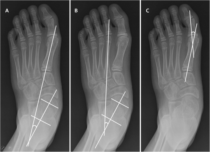 Progression of planovalgus deformity in patients with cerebral palsy | BMC  Musculoskeletal Disorders | Full Text