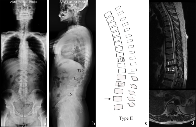 Analysis Of Sagittal Profile And Radiographic Parameters In Symptomatic Thoracolumbar Disc Herniation Patients Bmc Musculoskeletal Disorders Full Text