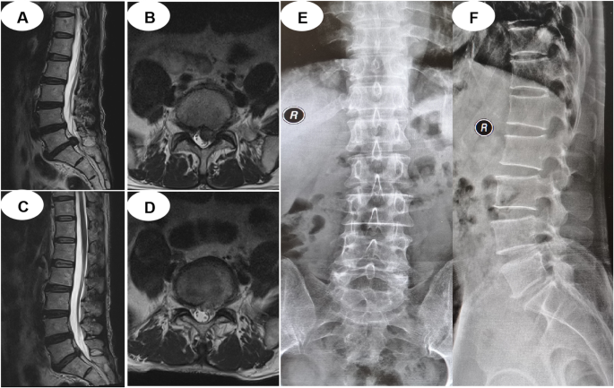 discectomy before and after