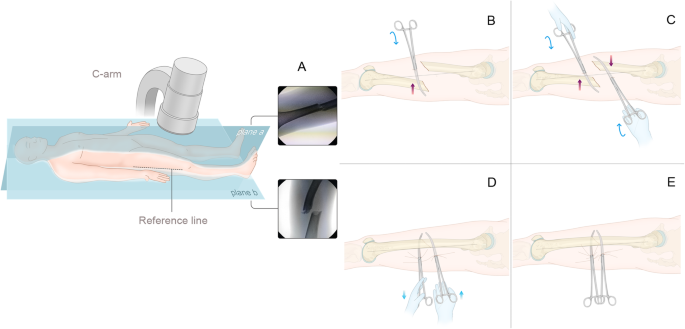 A novel closed reduction technique for treating femoral shaft fractures  with intramedullary nails, haemostatic forceps and the lever principle |  BMC Musculoskeletal Disorders | Full Text
