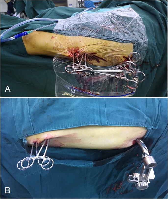 A novel closed reduction technique for treating femoral shaft fractures  with intramedullary nails, haemostatic forceps and the lever principle |  BMC Musculoskeletal Disorders | Full Text