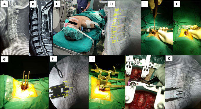 The aiming device for cervical distractor pin insertion: a proof-of-concept, feasibility study | BMC Musculoskeletal Disorders | Full Text The aiming device for cervical distractor pin insertion: a proof-of-concept, feasibility study | BMC Musculoskeletal Disorders | Full Text