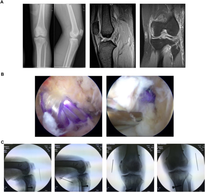 Multi-Ligament Knee Injury, Orthopedic Knee Specialist