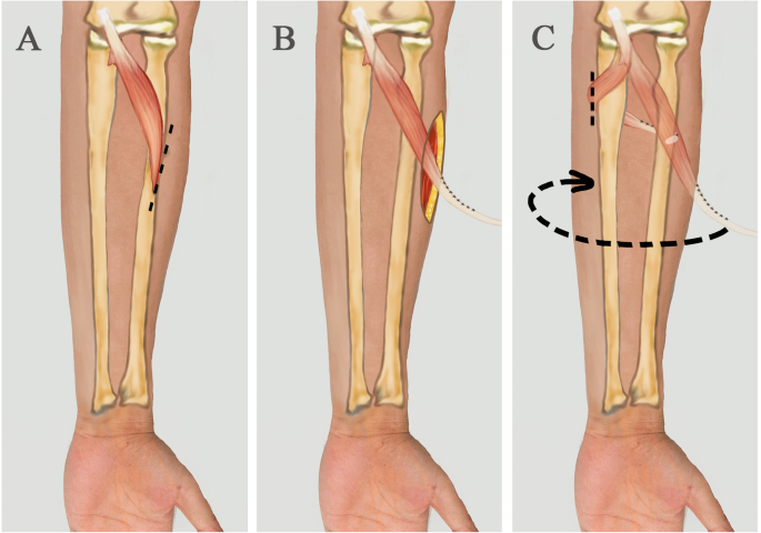 Pronation-supination movement angle.