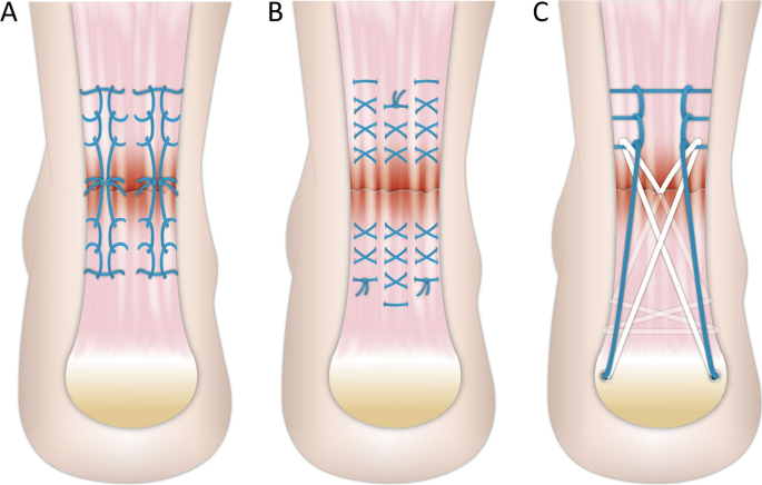 Jigless knotless internal brace versus other open Achilles tendon repairs  using a progressive rehabilitation protocol: a biomechanical study | BMC  Musculoskeletal Disorders | Full Text