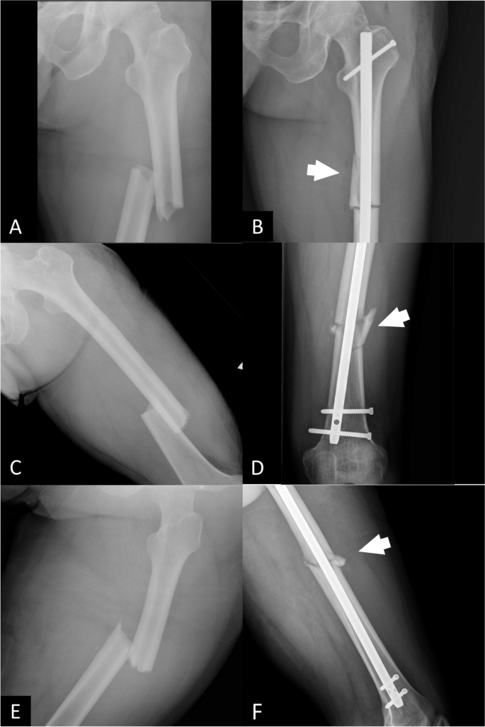 The characteristics and influence of iatrogenic fracture comminution  following antegrade interlocking nailing for simple femoral shaft  fractures, a retrospective cohort study | BMC Musculoskeletal Disorders |  Full Text