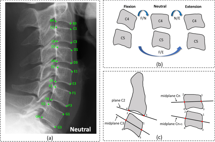 Rasterstereographical measurements (sagittal plane): (a) flèche