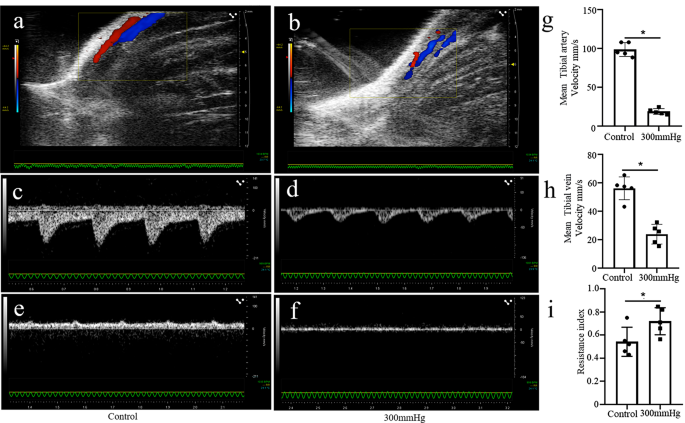 Paediatric acute compartment syndrome of the limbs due to fluid  extravasation: a case study - Wounds International