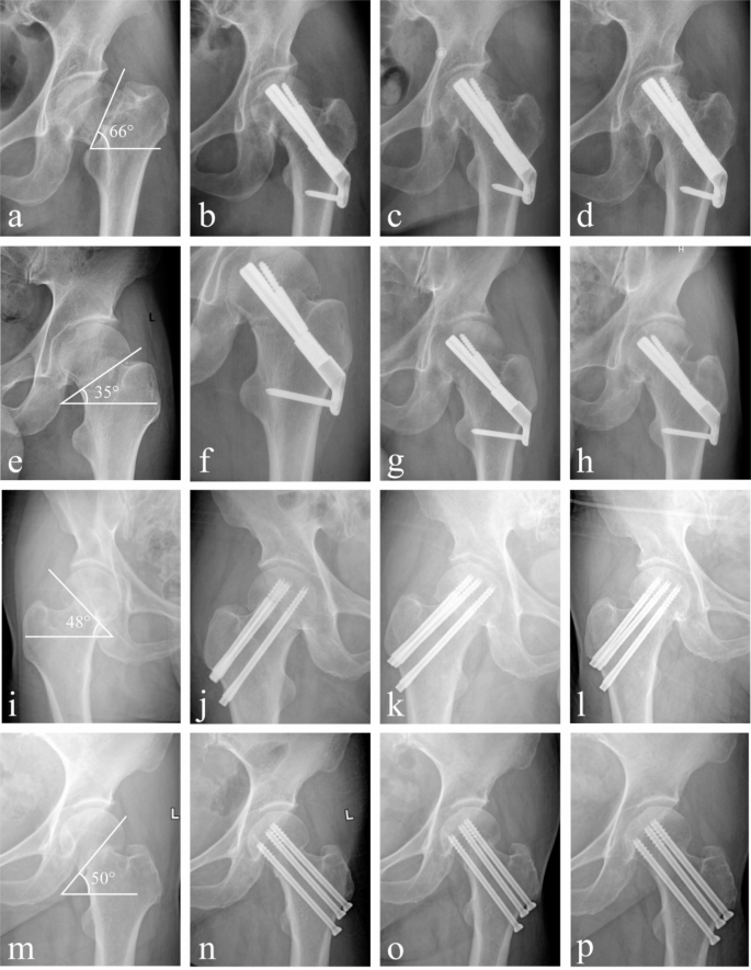case study fracture neck of femur figure 3