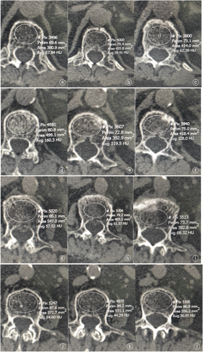 Feasibility study in quantitative identification of fresh and old  osteoporotic vertebral compression fracture by vertebral CT value and CT  value difference | BMC Musculoskeletal Disorders