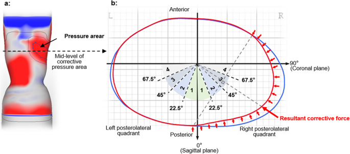 Effect of different corrective force directions applied by spinal orthoses on the patients with adolescent idiopathic scoliosis | BMC Musculoskeletal Disorders | Full Text
