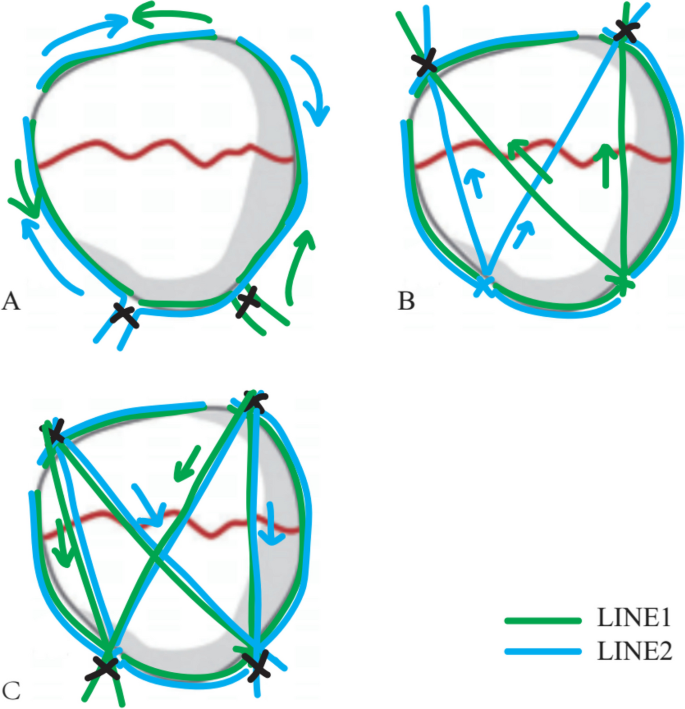 Finite element analysis of a novel patellar fracture fixation method ...