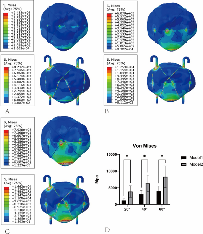 Finite element analysis of a novel patellar fracture fixation method ...