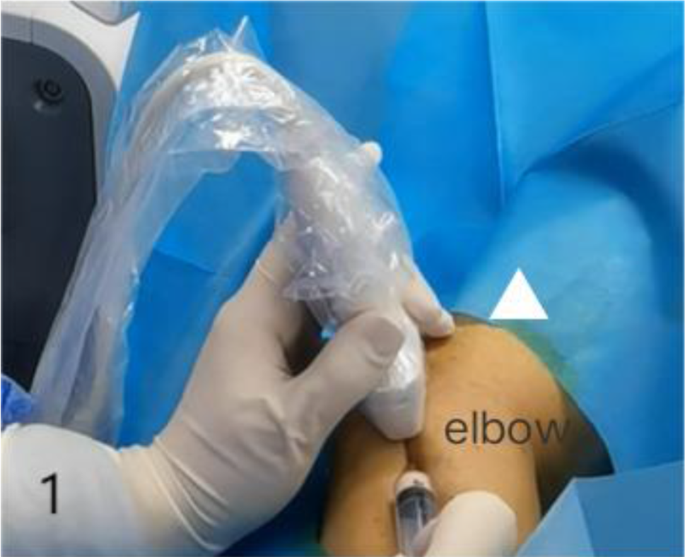 Multimodal ultrasound assessment of the injection therapy in lateral ...