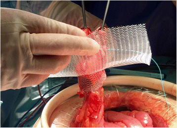 Preventing parastomal hernias with systematic intraperitoneal specifically  designed mesh | BMC Surgery | Full Text