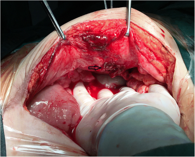 Spigelian hernia in the right upper abdominal wall: a case report | BMC  Surgery | Full Text