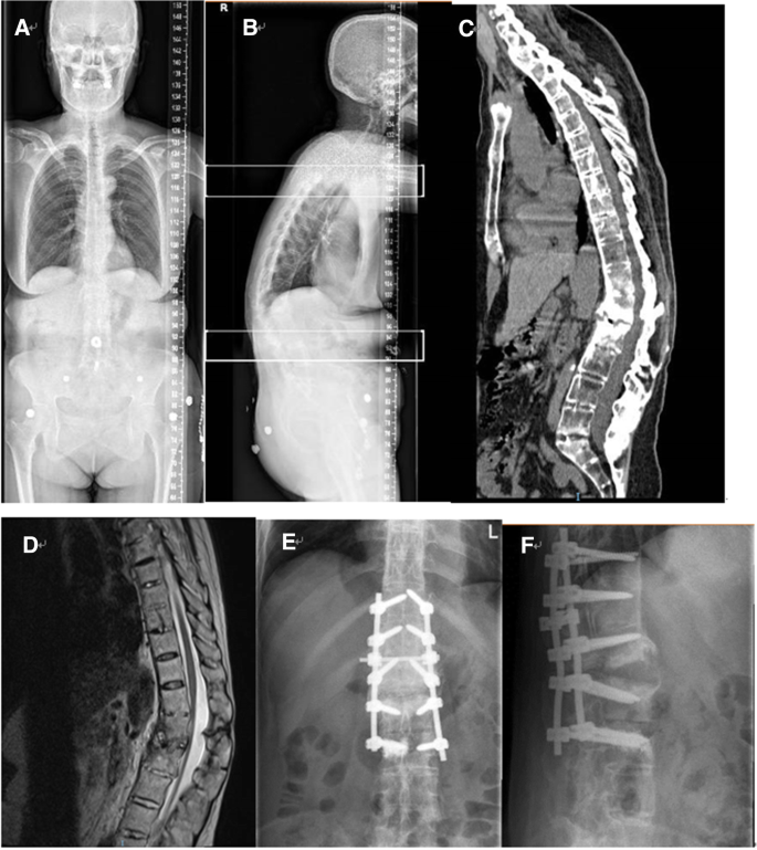 The Surgical Treatment Strategies For Thoracolumbar Spine Fractures With Ankylosing Spondylitis A Case Report Bmc Surgery Full Text The Surgical Treatment Strategies For Thoracolumbar Spine Fractures With Ankylosing Spondylitis A Case Report Bmc Surgery Full Text