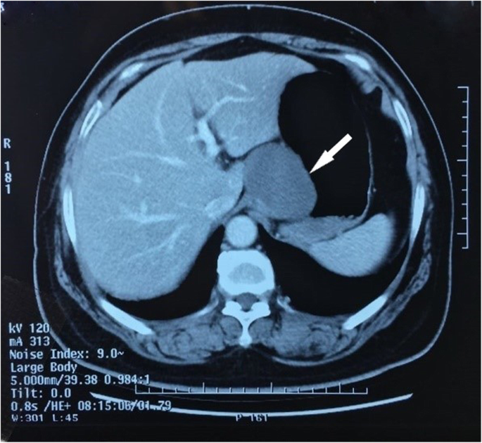 Ectopic Bronchogenic Cyst Of The Gastric Cardia Considered To Be A