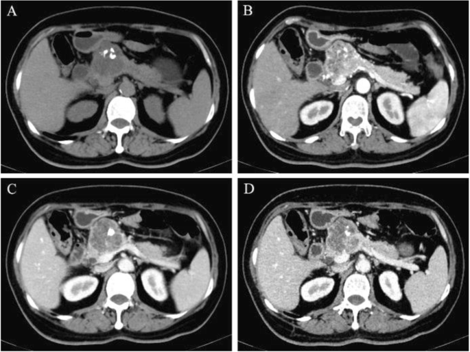 Adult pancreatic hemangioma: a rare case report and literature review | BMC  Surgery | Full Text