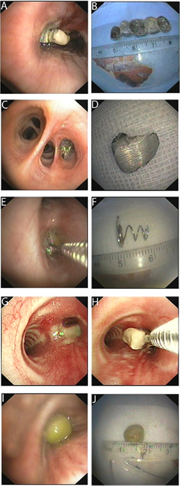 Application of flexible fiberoptic bronchoscopy in the removal of adult  airway foreign bodies | BMC Surgery | Full Text