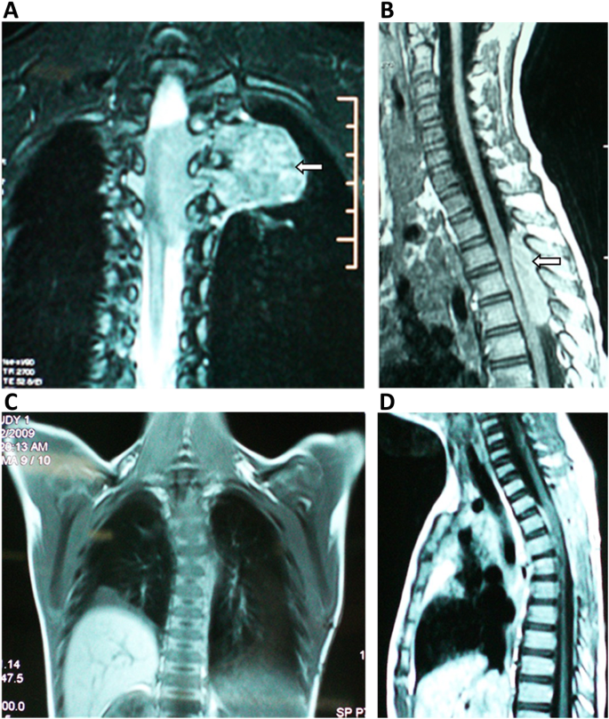 Kimura's disease mimicking thoracic spine dumbbell neurogenic tumor: a case  report and literature review | BMC Surgery | Full Text