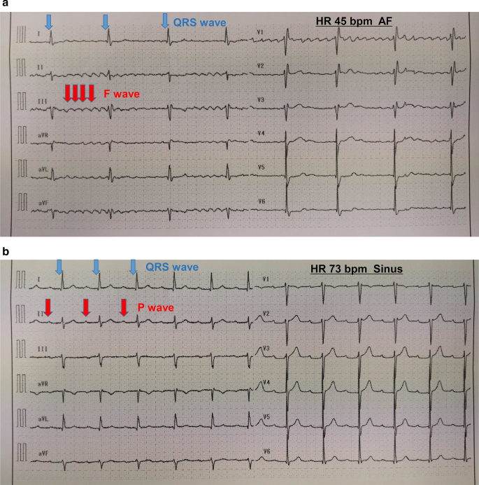 Temporary Pacemaker Insertion For Severe Bradycardia Following Pneumoperitoneum During Robot Assisted Radical Prostatectomy A Case Report Bmc Surgery Full Text